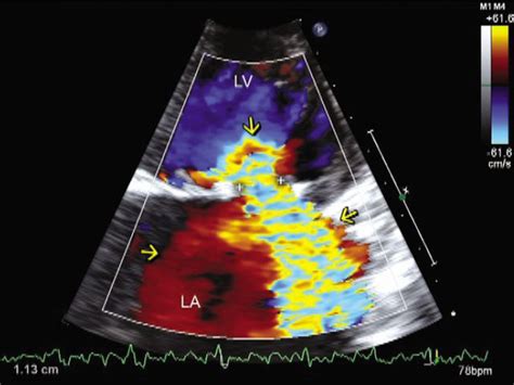 Two Dimensional Transthoracic Echocardiography In Apical Four Chamber