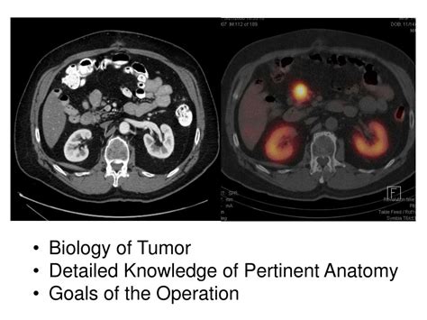 Ppt Gi Neuroendocrine Tumors Powerpoint Presentation Free Download