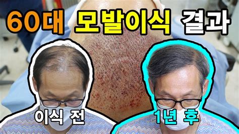 비절개모발이식 60대남성 복합형 탈모 모발이식 1년 경과 리얼후기 전후사진 동영상 Youtube