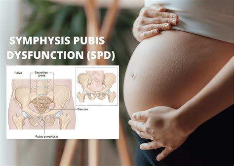 Symphysis Pubis Dysfunction SPD Orchard Health Clinic Osteopathy