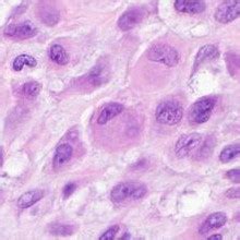 Epithelioid Fibrous Histiocytoma Is An Alk Rearranged Neoplasm