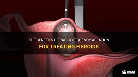 The Benefits Of Radiofrequency Ablation For Treating Fibroids MedShun