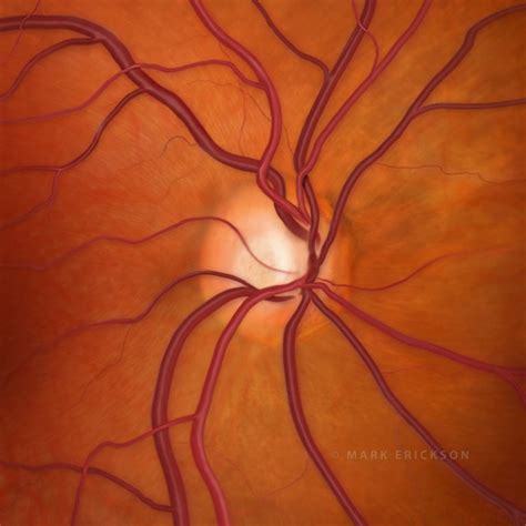 Optic Nerve Cupping In Glaucoma 0 6 C D Ratio Glaucoma Illustration