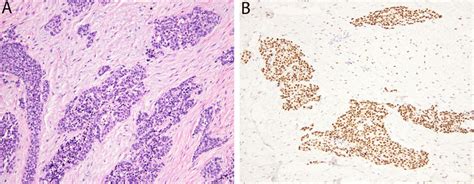 Desmoplastic Small Round Cell Tumor A Irregular Islands Of