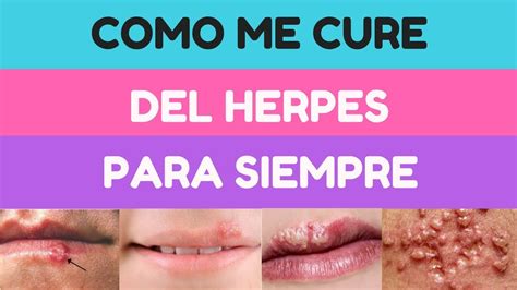 Como Eliminar El Herpes Para Siempre Mi Experiencia YouTube