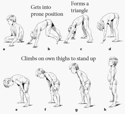 Gower’s sign | Epomedicine