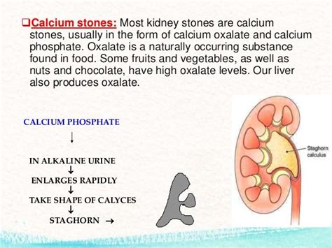 Presentation Kidney Stone Final