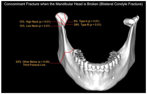 Neck Of Mandible