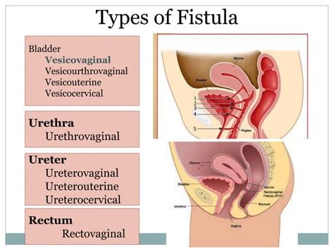 Genital Tract Fistula PPT