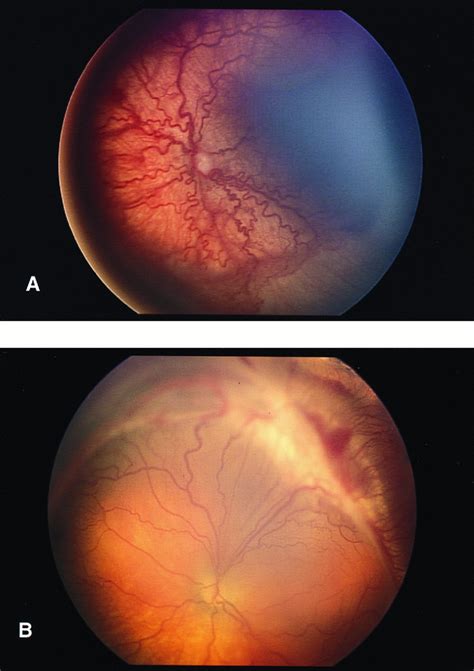 Telemedical Evaluation And Management Of Retinopathy Of Prematurity