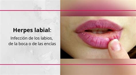 Todo Lo Que Debes Saber Sobre El Herpes Labial Blog De Masquemedicos