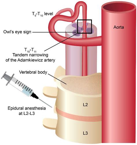 Medicines Free Full Text Postpartum Spinal Cord Infarction A Case Report And Review Of The