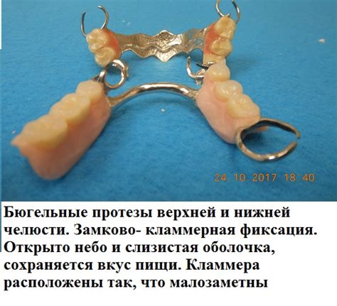 Протезирование зубов виды современных зубных протезов