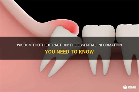 Wisdom Tooth Extraction The Essential Information You Need To Know Medshun