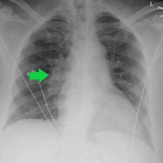 Portable Semi Upright Anteroposterior Radiograph Of A 66 Year Old