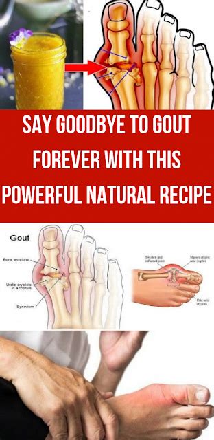 Say Goodbye To Gout Forever With This Powerful Natural Recipe Gout