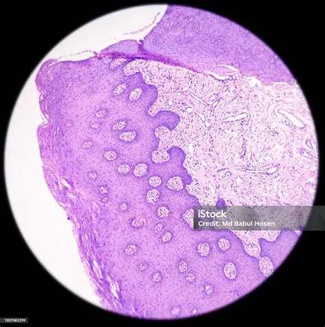 Buccal Mucosa Squamous Hyperplasia Show Hyperplastic Squamous