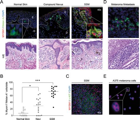 Mysm1 Expression In Normal Human Skin Nevi Primary Melanoma And Download Scientific Diagram