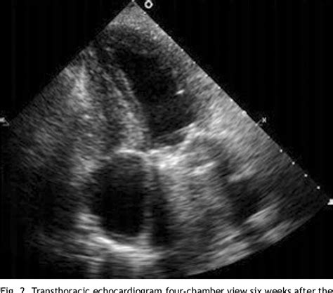 Figure 1 From Case Report Cardiac General Takotsubo Cardiomyopathy After Elective Mitral Valve