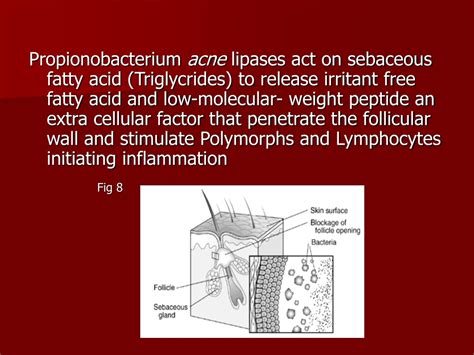 Ppt Acne Disorders Of Sebaceous Gland Powerpoint Presentation Free Download Id9577232