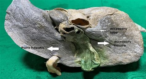 Pons Hepatis Bridging The Quadrate Lobe With Left Lobe Over Fissure For