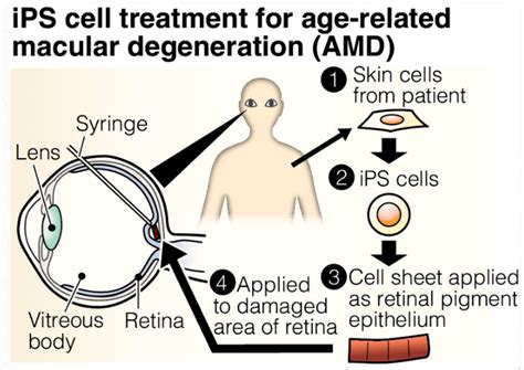 iPS cell treatment for age-related macular degeneration (AMD)