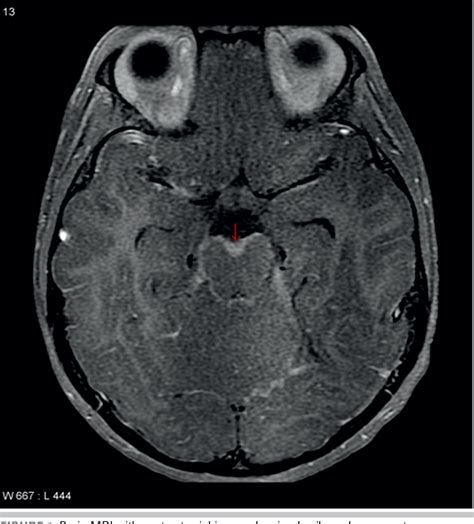 Figure 1 from Tuberculosis meningitis. | Semantic Scholar