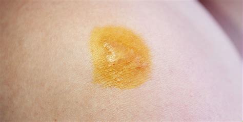 skin test  iodine greatlifeeu