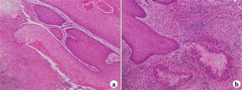 Histopathologic Examination Findings In Case 2 A Hyperplasia Of Download Scientific Diagram