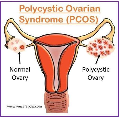 Polycystic Ovarian Syndrome PCOS We Care