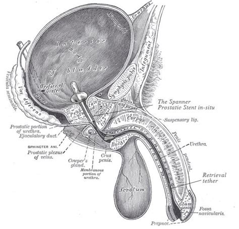 Prostatic stent - Alchetron, The Free Social Encyclopedia