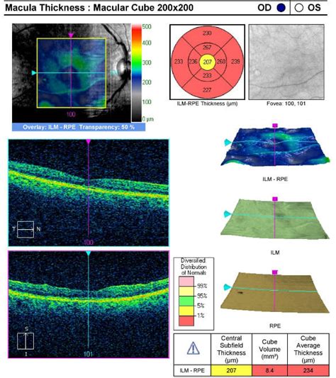 Diabetes-Induced Retinal Ischemia - Decision-Maker PLUS