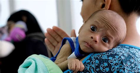 Desnutri O Pode Matar Mil Crian As A Mais Pandemia