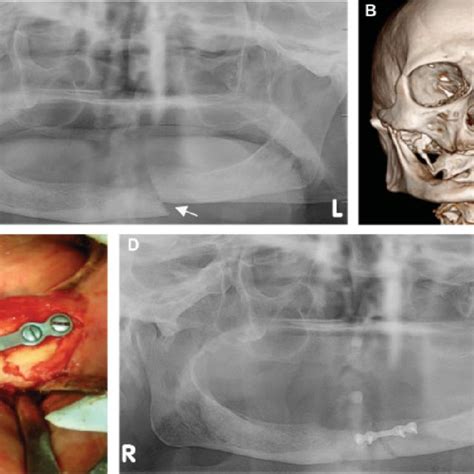 A Preoperative Orthopantamogram Arrow Shows The Left Parasymphysis