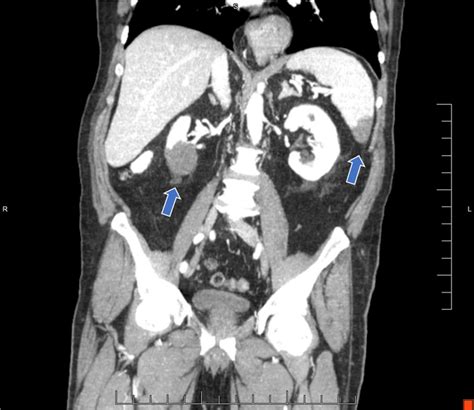 Cta Of The Abdomen And Pelvis Demonstrating Splenic And Renal Infarcts Download Scientific