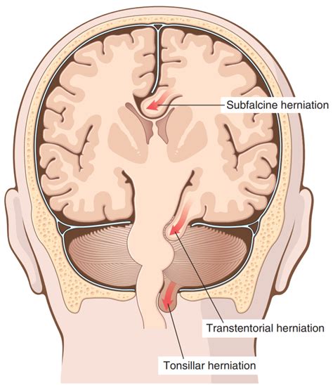 Transtentorial Herniation