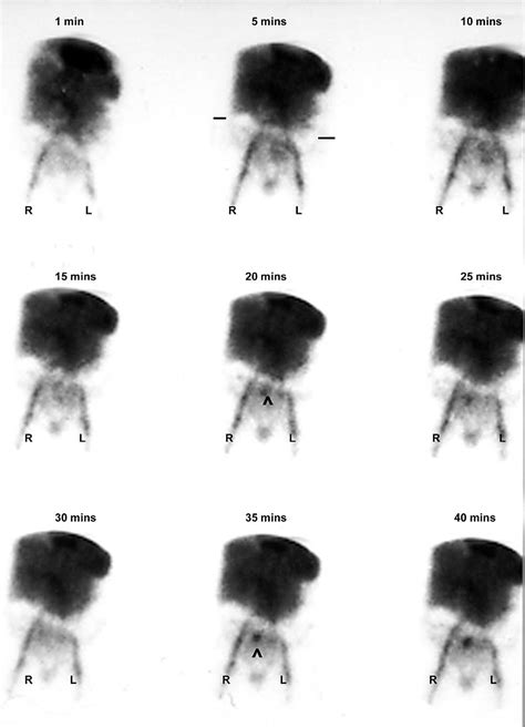 Figure 1 From The Role Of Nuclear Medicine In The Detection Of Acute