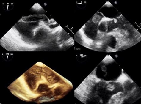 Transesophageal Echocardiography Tee And 3d Tee A Large Mass Download Scientific Diagram