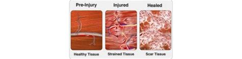 Everything You Need To Know About Scar Tissue Joondalup Wa Pain