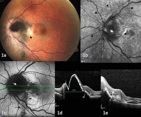 Management Of Optic Disc Melanocytoma Associated With Choroidal Neovascularisation And Macular