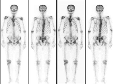 Bone Scintigraphy Before Treatment Download Scientific Diagram