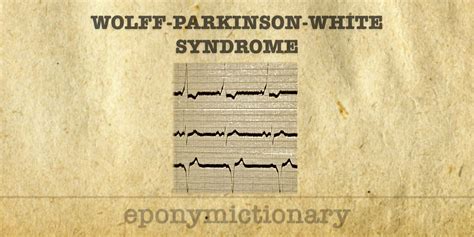 Wolffparkinsonwhite Syndrome • Litfl • Medical Eponym Library