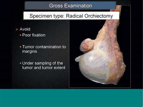 CAP Education Session Testicular Cancer Dr Yilmaz 2012 YouTube