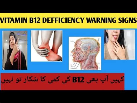 Vitamin B Deficiency Symptoms Vitamin B Ki Kami Se Kya Hota Hai