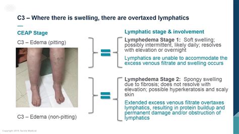 Pitting Edema Lymphedema