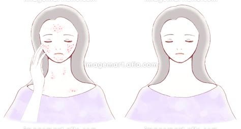 ニキビに悩む女性の顔と吹き出物のない女性の顔 比較 ビフォーアフターのイラスト素材 143682633 イメージマート