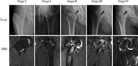 Avascular Necrosis Of Femoral Head Mri