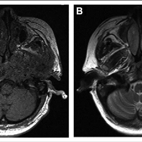 A T Weighted Magnetic Resonance Mr Image Showing Isointense Signals