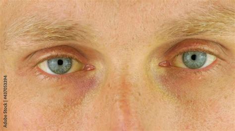 Mens Eyes Obstructive Jaundice Yellowish Real People Liver Dysfunction