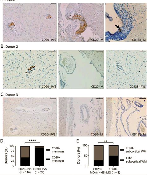 Figure From Heterogeneity Of The Immunopathology In Advanced Multiple